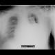 Fluidothorax, hemothorax and pneumothorax, complication of evacuation: X-ray - Plain radiograph